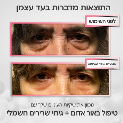 AuraGlow™ - מכשיר להפחתת נפיחות ושקיות מתחת לעיניים